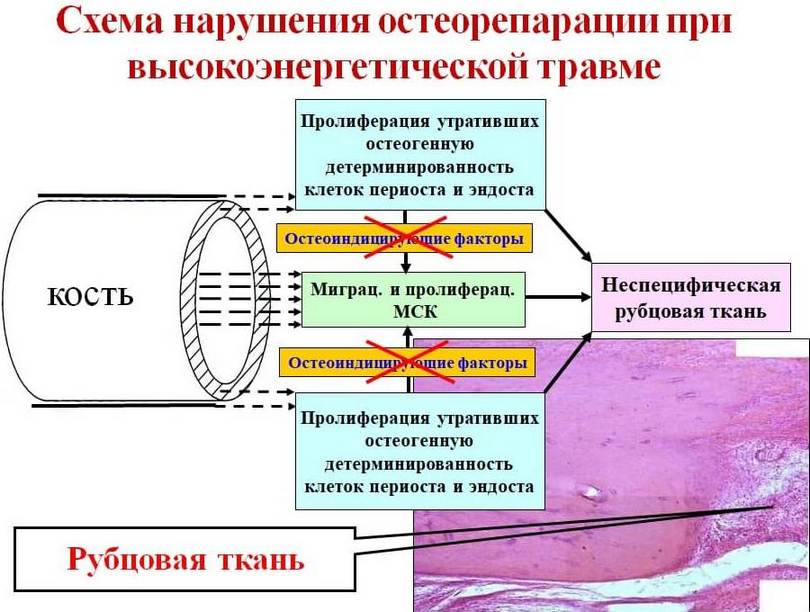 Cellular Mechanisms of Impaired Fracture Healing