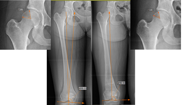 Diagram showing medial shift of the femoral load axis in hip osteoarthritis before surgical correction
